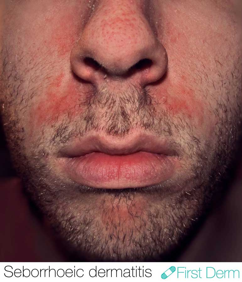 FirstDermSeborrhoeicDermatitisPictureUpperLipICD10L21