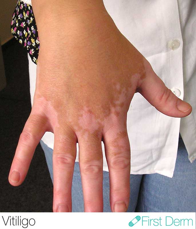 Vitiligo- hand ICD-10-L80
