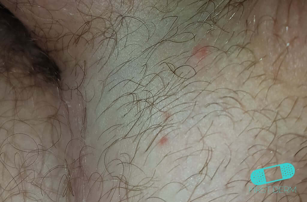Folliculitis Barber S Itch Online Dermatology