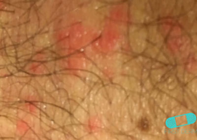 Folliculitis (Barber’s Itch) (03) chest [ICD-10 L73.9]