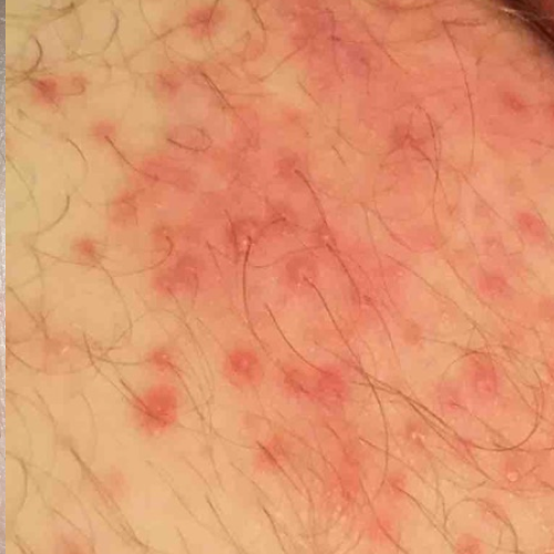 Invers psoriasis: Hur ser det ut?
