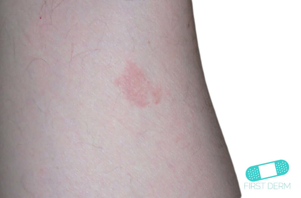 Marcas Frutilla (Hemangioma)