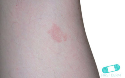 Marcas Frutilla (Hemangioma)