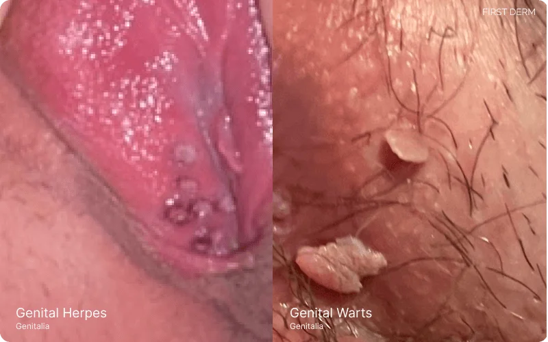 Two genital conditions on the vaginal area: Genital Herpes represented by small grouped blisters on red inflamed skin, and Genital Warts depicted as keratinized hard papules