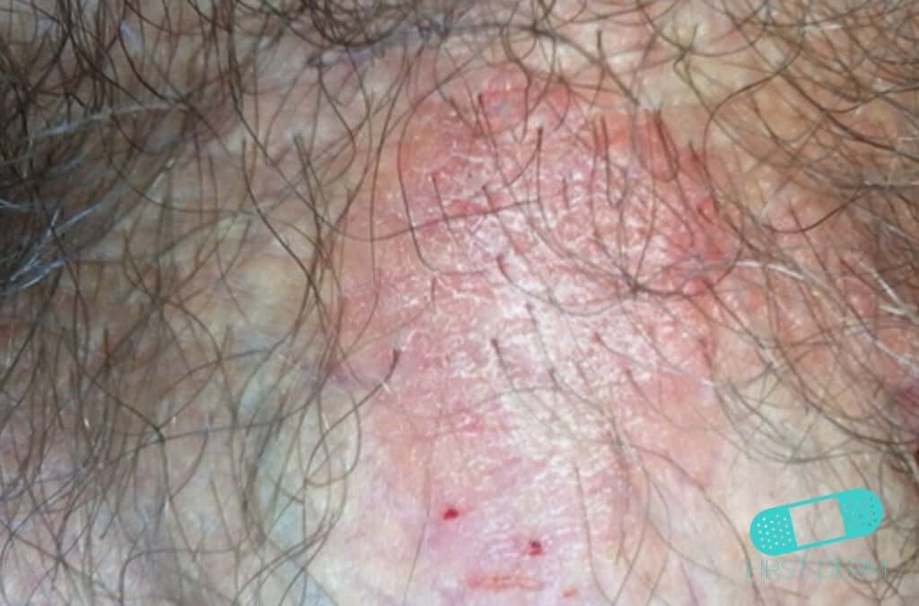 pictures of male genital psoriasis