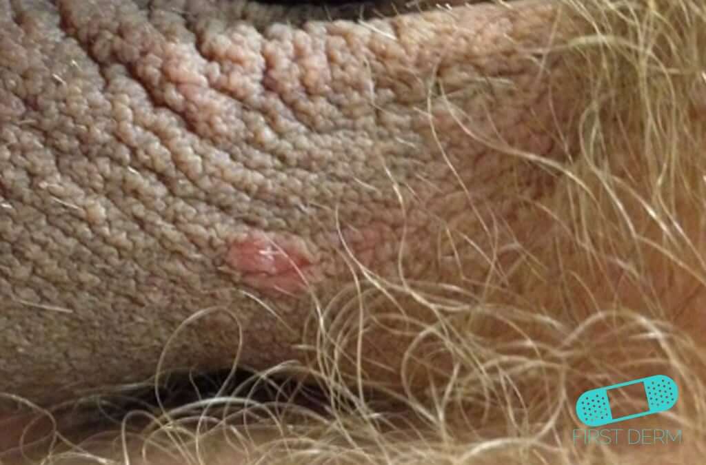 pictures of male genital psoriasis)