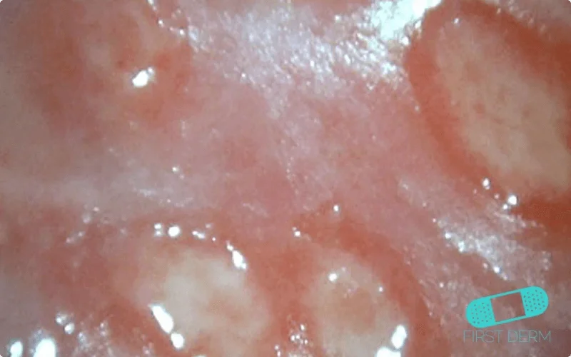 A close-up photo of a red and inflamed genital sore on the skin. The sore has a raised border and a yellowish center