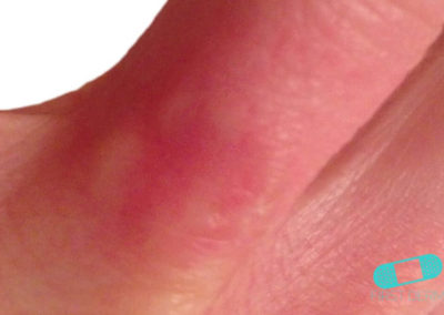 Granuloma Annulare (18) finger [ICD-10 L92.0]