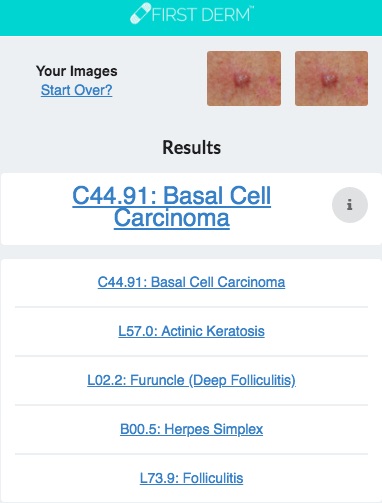 Health Chatbot Basal Cell Carcinoma Skin Image Search NHS