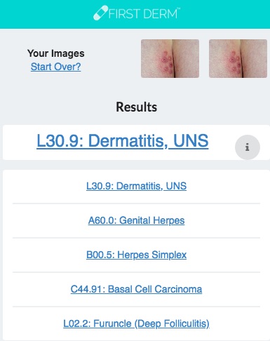 Health Chatbot Genital Herpes Skin Image Search NHS