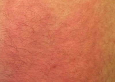 Hives (Urticaria) (17) skin [ICD-10 L50]