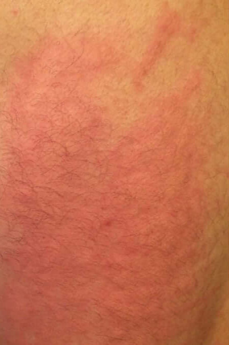 Hives (Urticaria) (17) skin [ICD-10 L50]