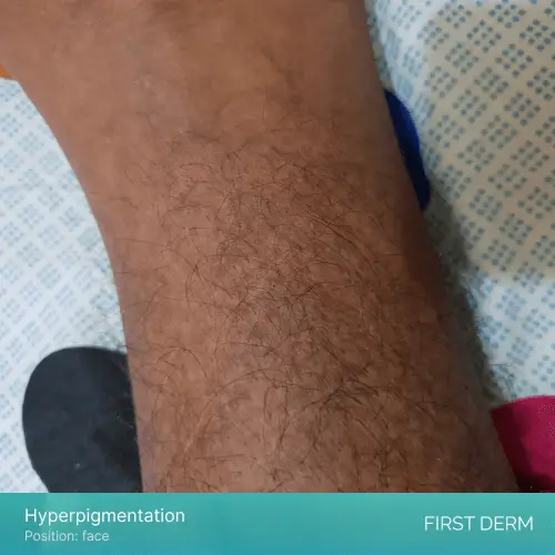 Image of hyperpigmentation on the hand of an individual with dark brown skin tone, located near the wrist. The affected area appears darker than the surrounding skin and has a patchy, uneven texture