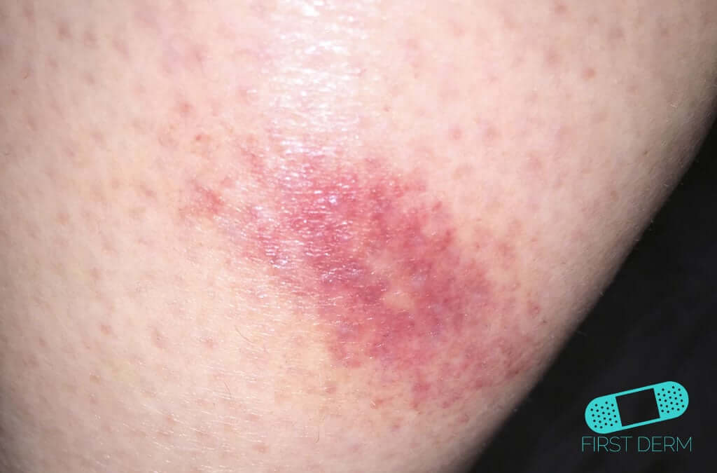 Insect Bite - Online Dermatology
