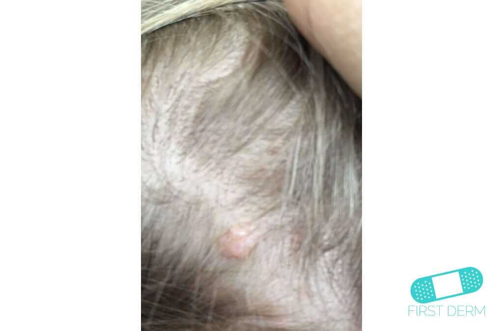 Intradermal nevus Online Dermatology