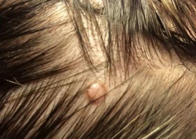 Intradermal nevus (18) scalp hair [ICD-10 D22.9]