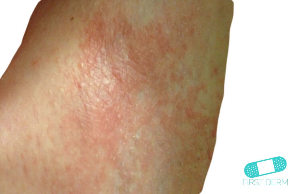 Irritative eczema (Irritant Contact Dermatitis) Online Dermatology