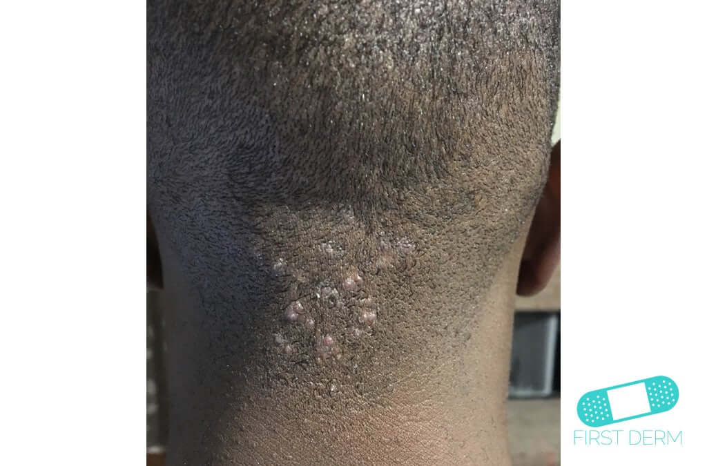 Keloid (Hypertrophic Scar)
