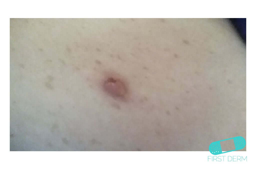 Keratoacanthoma - Online Dermatology