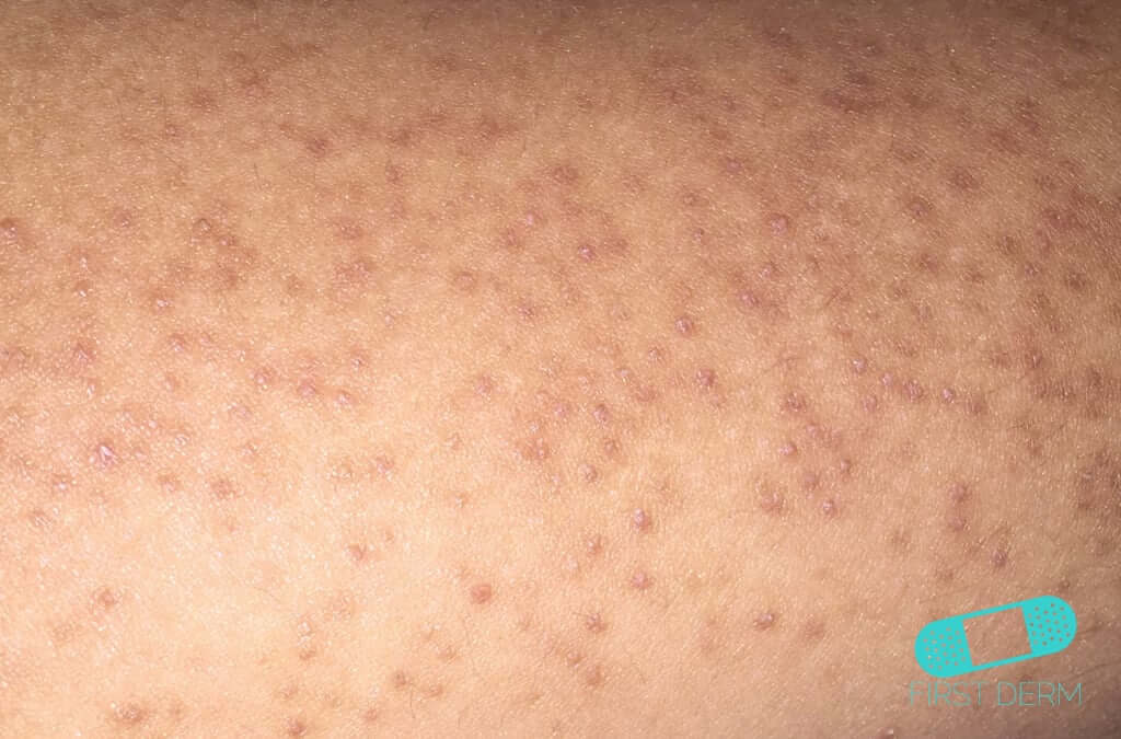Keratosis pilaris