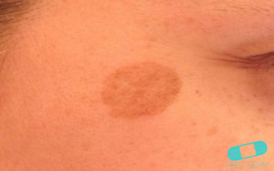 Lentigo solaris (solfläckar)