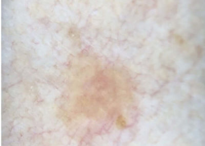 Lentigo solaris (solfläckar) (17) hud dermatoskopi [ICD-10 L81.4]
