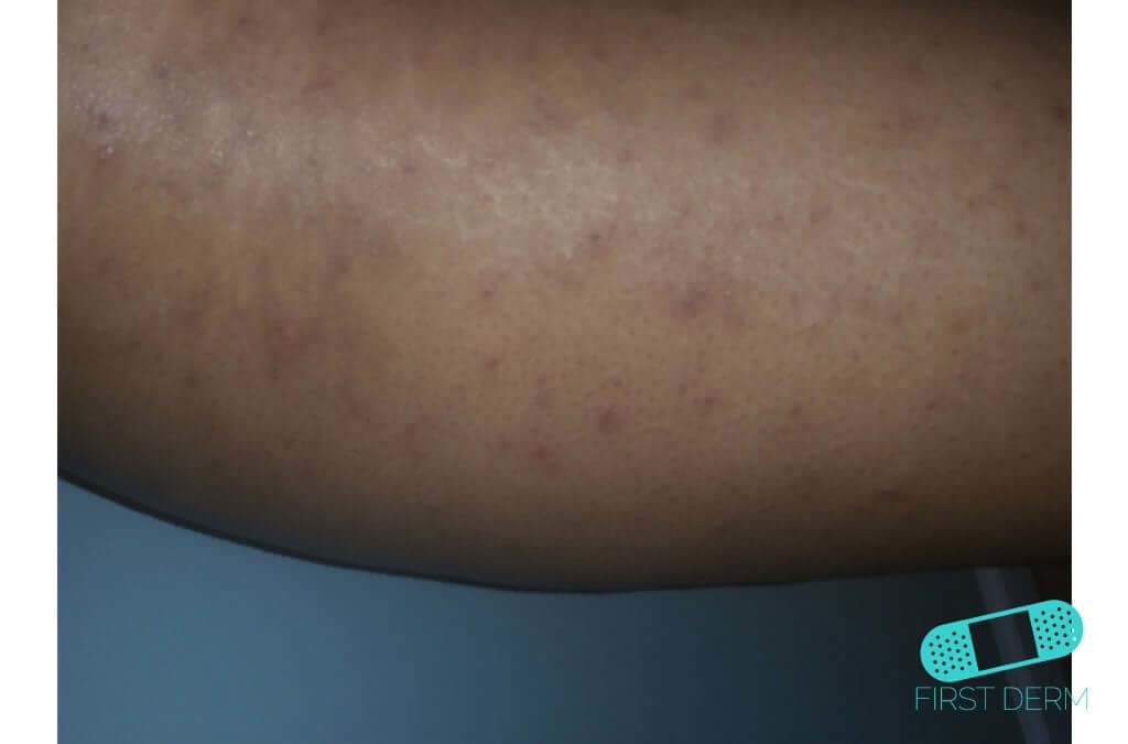 Lichen planus