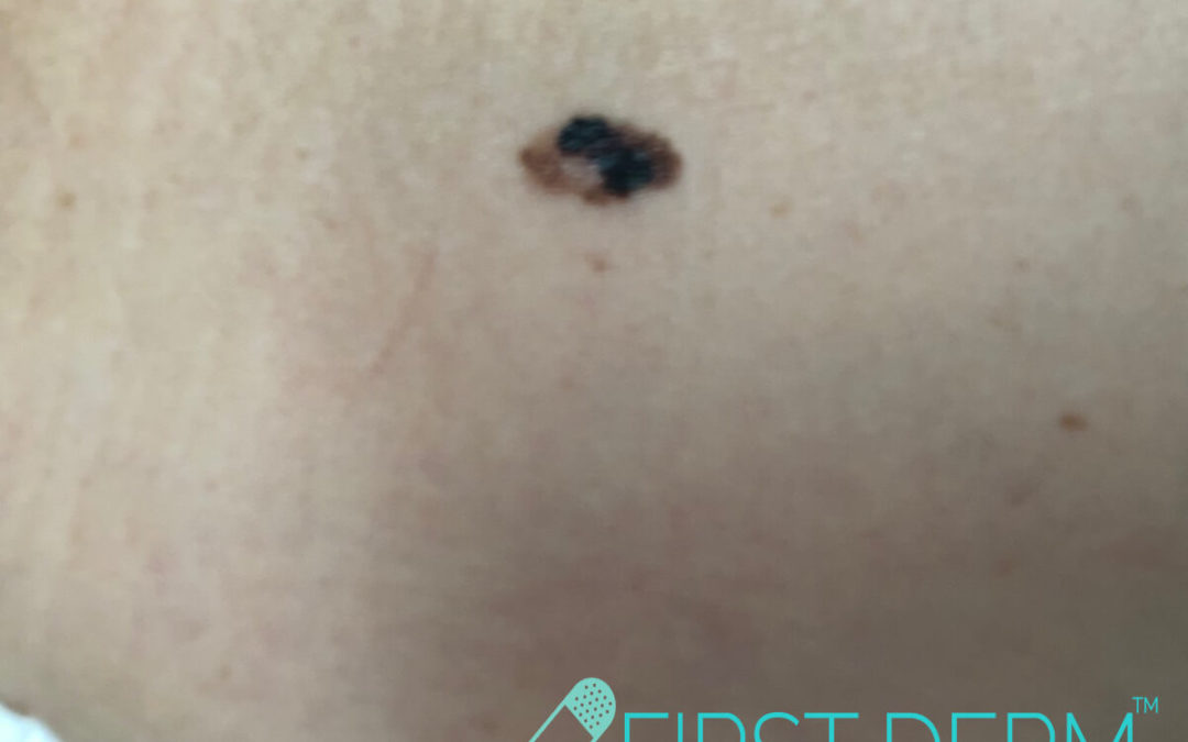 Malignant Melanoma