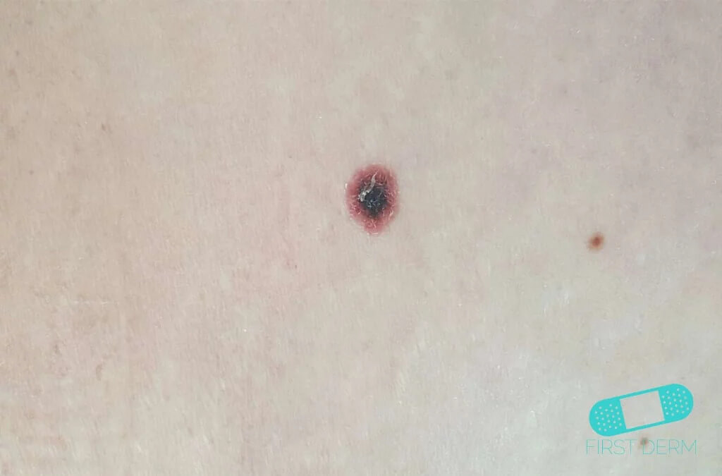 Malignant Melanoma (27) stomach [ICD-10 C43.9] showing the characteristic dark, irregularly shaped mole associated with skin cancer