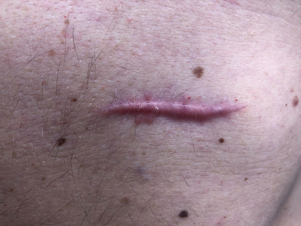 Friend malignant melanoma in situ chest scar tissue 42 year old male Sweden
