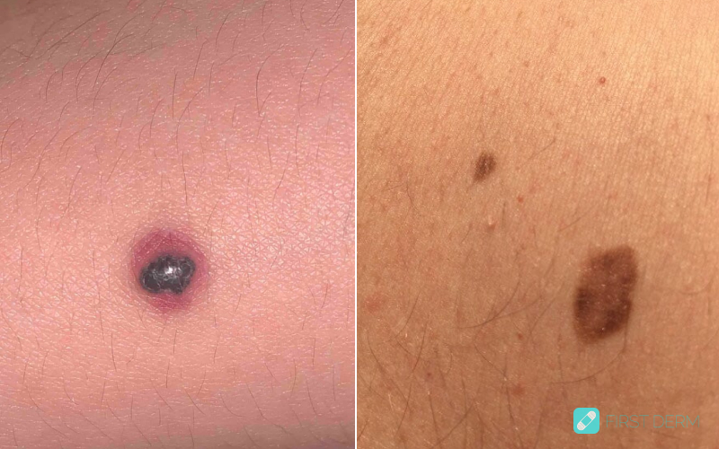 malignant melanoma on the chest, showing a dark and irregularly shaped mole, with uneven color and irregular borders