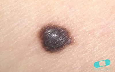 Malignt melanom