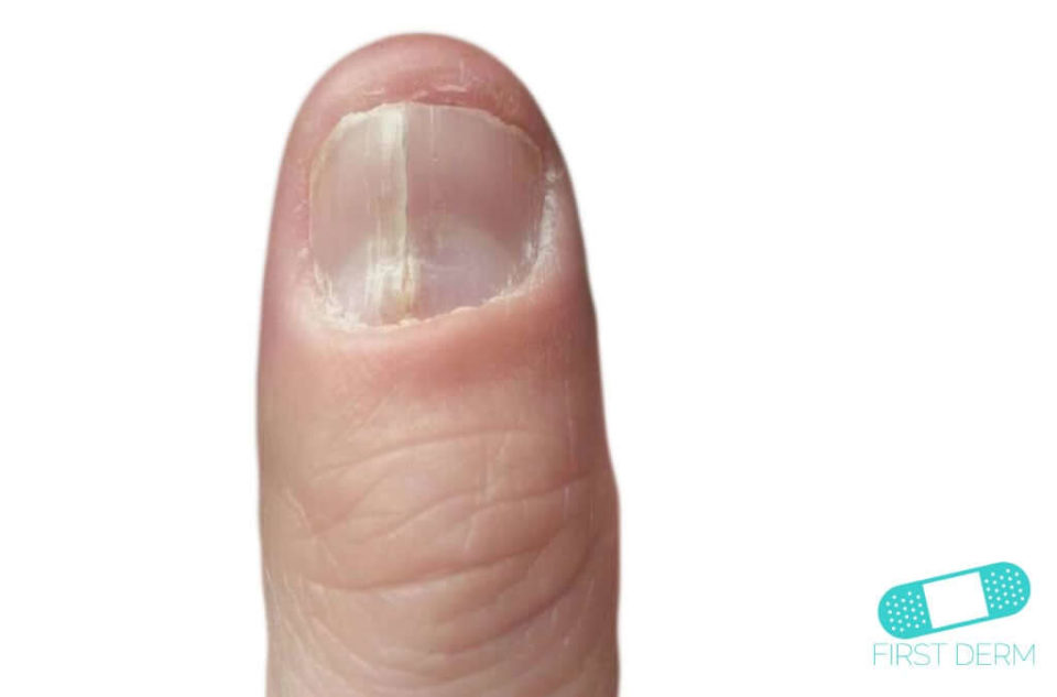 Median Nail Dystrophy (01) finger nail [ICD-10 L60.3]