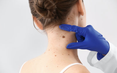 Skin Tag and Mole Removers: Are They Safe?