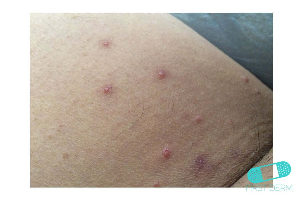 Molluscum contagiosum (Water warts) Online Dermatology