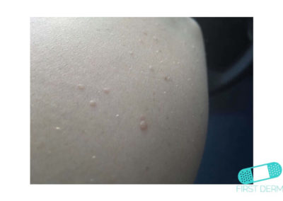 Molluscum contagiosum (Water warts) (20) skin [ICD-10 B08]