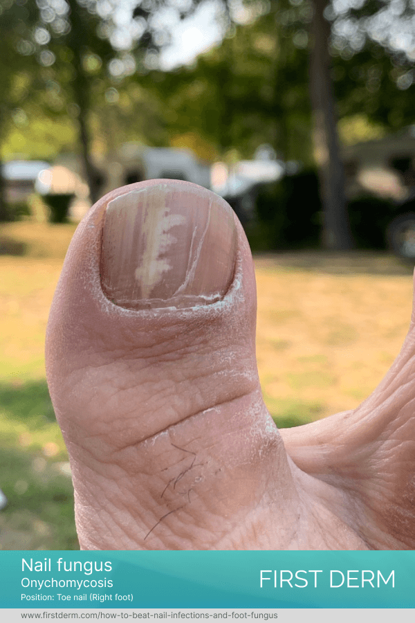 A close-up photograph of a toenail affected by a fungal nail infection, with discoloration and thickening of the nail visible
