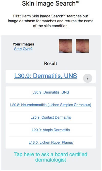 Netdoctor Atopic Dermatitis arm child AI