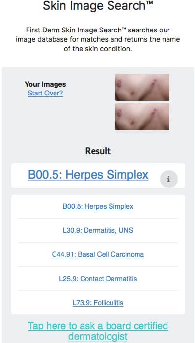 Netdoctor Herpes Simplex chest child AI