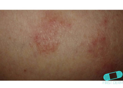 Nummular Eczema (Discoid Dermatitis) (14) skin [ICD-10 L30.0]