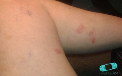 Eccema Numular (Dermatitis Discoide)