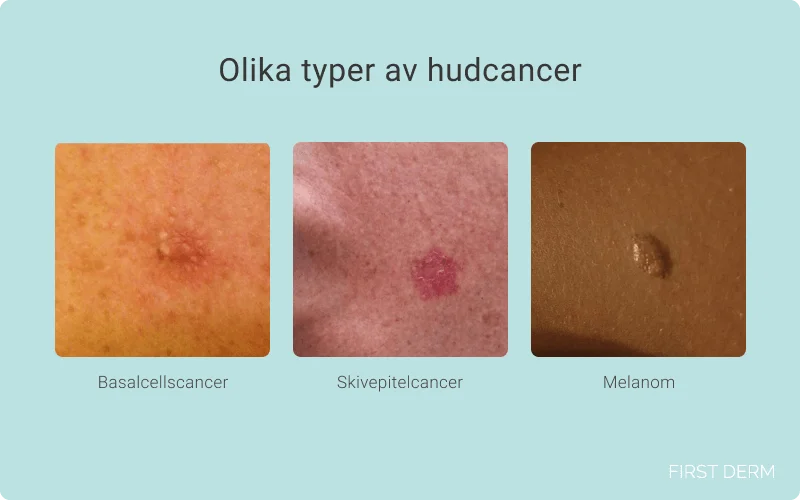bilder av 3 huvudtyper av hudcancer: basalcellscancer, skivepitelcancer och melanom