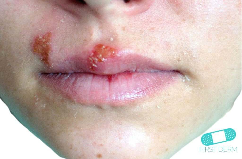 Oral herpes (munsår)