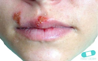 Oral herpes (munsår)