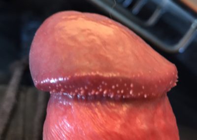 Pearly Penile Papules - Hirsuties coronae glandis - Penis