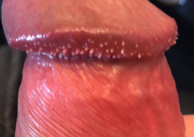 Pearly Penile Papules - Hirsuties coronae glandis - Penis ridge close up