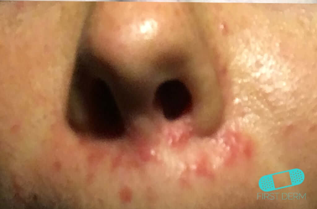 Dermatitis Perioral
