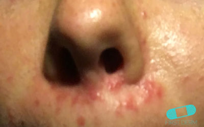 Perioral dermatit