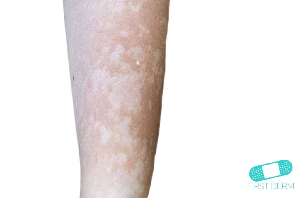 Pityriasis Versicolor (Tinea Verisicolor) Online Dermatologist