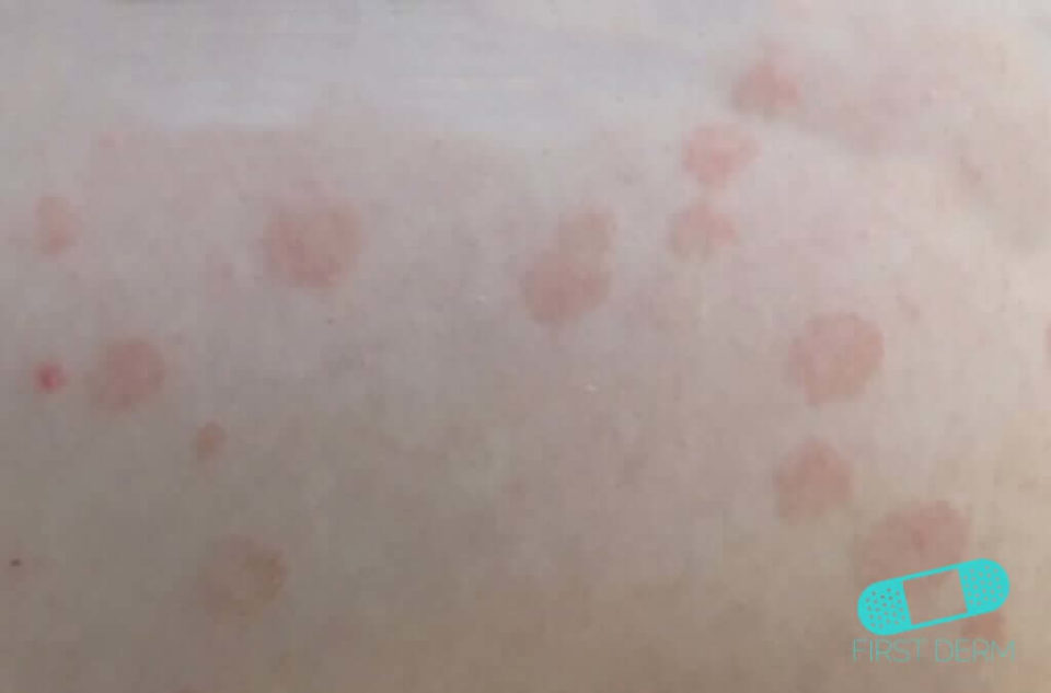 Itchy Rash Pictures 6 most common cases and their treatment